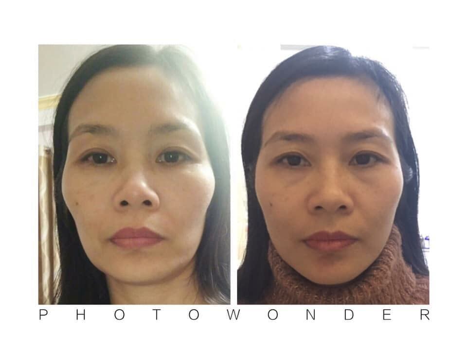 Nắn chỉnh thẩm mỹ ( Hadoo moon)